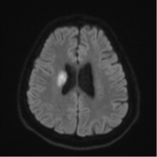 File:CNS vasculitis (Radiopaedia 55715-62263 Axial DWI 49).png