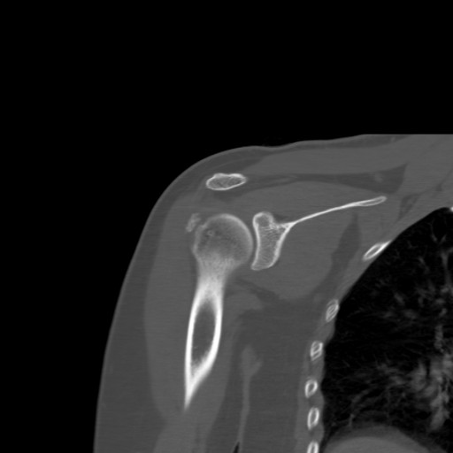File:Calcific tendinitis of the infraspinatus tendon (Radiopaedia 87256-103539 Coronal bone window 29).jpg