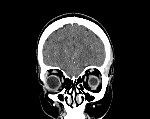 Calcified cerebral hydatid cyst (Radiopaedia 65603-74717 C 11).jpg