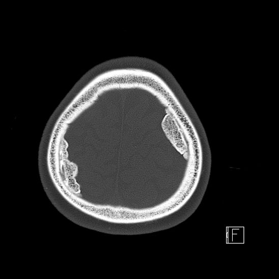 Calcified chronic subdural hematoma (Radiopaedia 77374-89492 Axial bone window 122).jpg