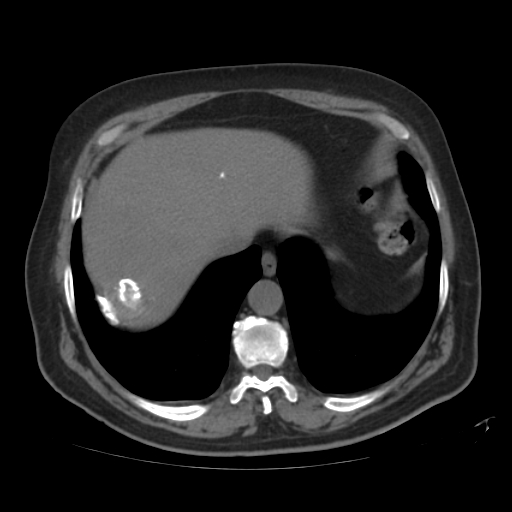 File:Calcified hepatic hydatid cyst (Radiopaedia 18907-18853 Axial non-contrast 5).jpg