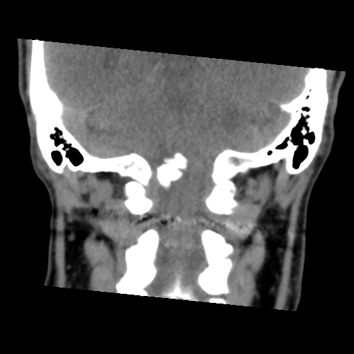 Calcifying pseudoneoplasm of neuraxis (Radiopaedia 44076-47617 Coronal non-contrast 30).png