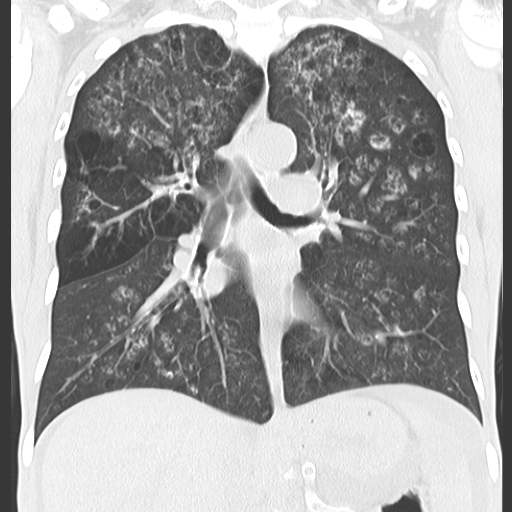 File:Calciphylaxis and metastatic pulmonary calcification (Radiopaedia 10887-11318 Coronal lung window 4).jpg