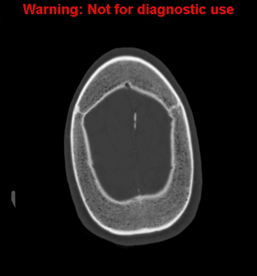 File:Calvarial thickening from chronic shunting (Radiopaedia 60079-67637 Axial bone window 163).jpg