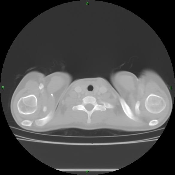 File:Cannon ball metastases - synovial sarcoma (Radiopaedia 26135-26271 Axial lung window 2).jpg