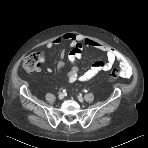 Cannonball metastases from endometrial cancer (Radiopaedia 42003-45031 E 54).png