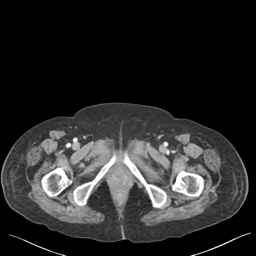 Cannonball metastases from endometrial cancer (Radiopaedia 42003-45031 E 80).png