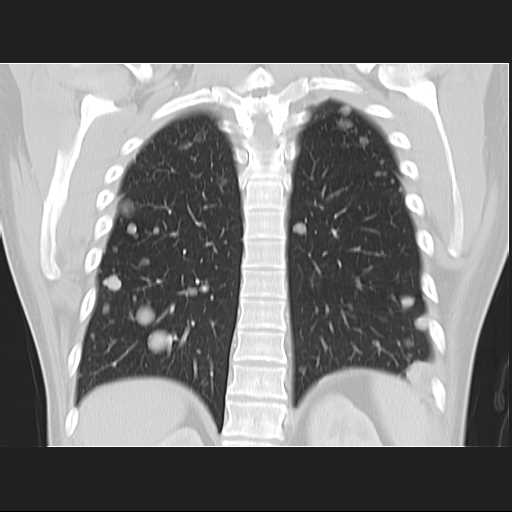 File:Cannonball pulmonary metastases (Radiopaedia 67684-77101 C 19).jpg