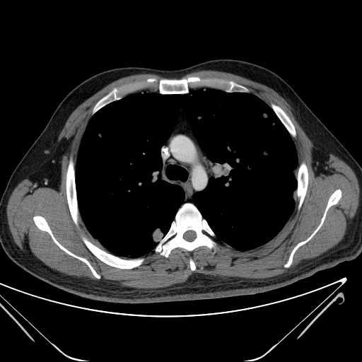 File:Cannonball pulmonary metastases (Radiopaedia 67684-77101 D 100).jpg