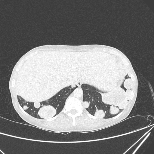 Canonball lung metastasis (Radiopaedia 77634-89837 Axial lung window 157).jpg