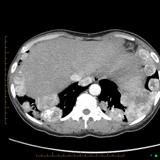 Canonball lung metastasis (Radiopaedia 77634-89837 B 86).jpg