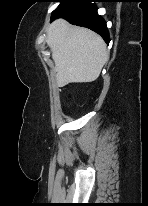 Carcinoid tumor - terminal ileum (Radiopaedia 60931-68739 C 90).jpg