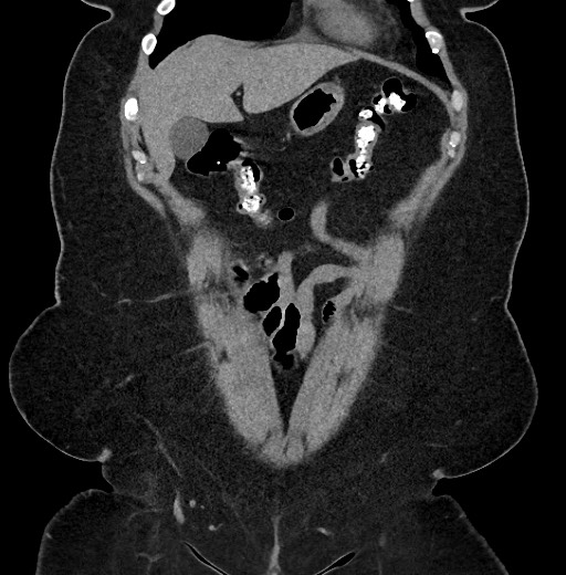 Carcinoid tumor - terminal ileum (Radiopaedia 60931-68740 Coronal non-contrast 18).jpg