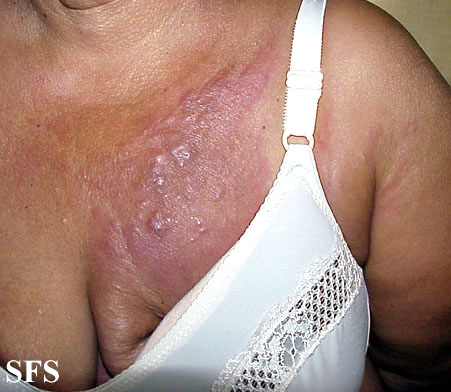 Carcinoma Erysipeloides (Dermatology Atlas 12).jpg