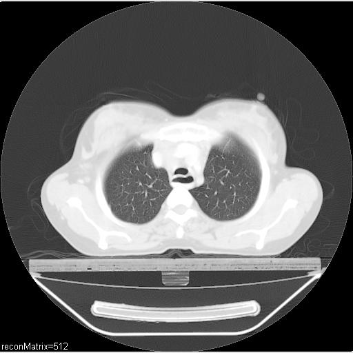 File:Carcinoma of esophagus (Radiopaedia 27356-27550 Axial lung window 26).jpg