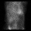 Cardiac amyloidosis (Radiopaedia 51404-57239 A 6).jpg