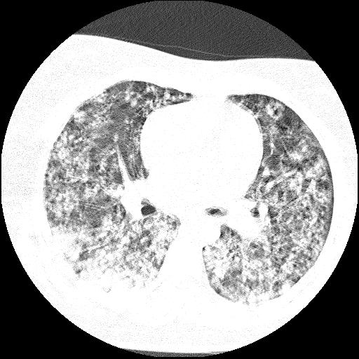 Cardiac angiosarcoma (Radiopaedia 66010-75181 Axial lung window 50).jpg