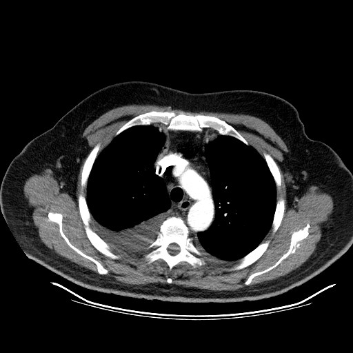 File:Cardiac lymphoma (Radiopaedia 38690-40836 Axial C+ CTPA 3).jpg