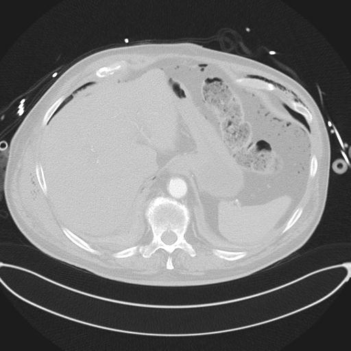 Cardiac trauma (Radiopaedia 32874-33858 Axial lung window 49).jpg