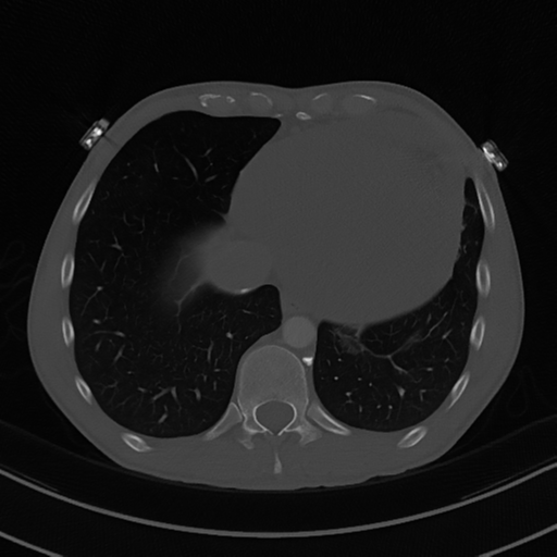 Cardiac tumor - undifferentiated pleomorphic sarcoma (Radiopaedia 45844-50134 Axial bone window 54).png
