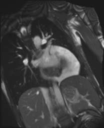 File:Cardiac tumor - undifferentiated pleomorphic sarcoma (Radiopaedia 45844-50136 Oblique T2 15).png