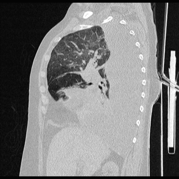 Cardiogenic pulmonary edema (Radiopaedia 29213-29609 Sagittal lung window 34).jpg