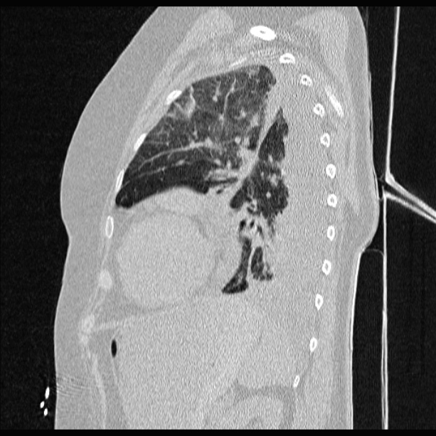 Cardiogenic pulmonary edema (Radiopaedia 29213-29609 Sagittal lung window 71).jpg