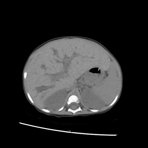 File:Caroli disease with autosomal recessive polycystic kidney disease (ARPKD) (Radiopaedia 89651-106703 Axial non-contrast 16).jpg