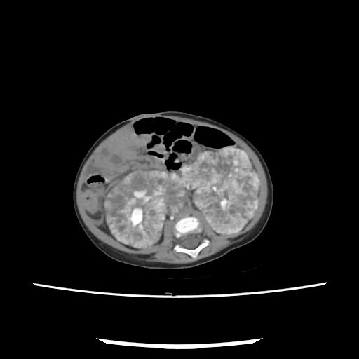 Caroli disease with autosomal recessive polycystic kidney disease (ARPKD) (Radiopaedia 89651-106703 E 142).jpg