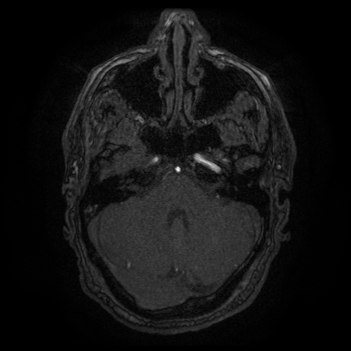 Carotid arterial dissection with acute cerebral infarction (Radiopaedia 26636-26784 MRA 132).jpg