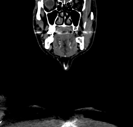 File:Carotid body tumor (Radiopaedia 83615-98727 B 27).jpg