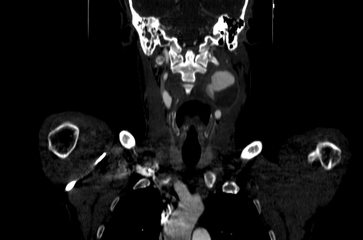 File:Carotid bulb pseudoaneurysm (Radiopaedia 57670-64616 D 28).jpg