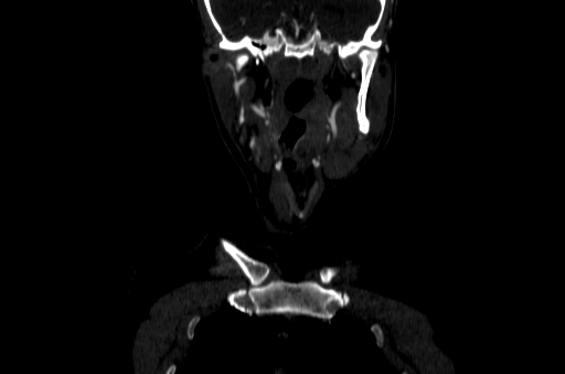 File:Carotid bulb pseudoaneurysm (Radiopaedia 57670-64616 D 3).jpg