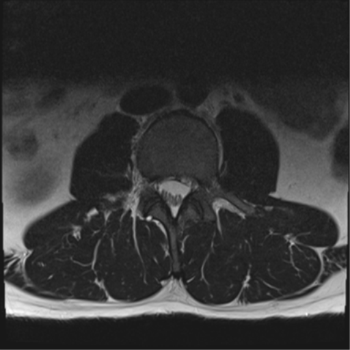 File:Cauda equina syndrome (Radiopaedia 53615-59672 Axial T2 24).png