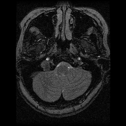 Cavernoma, DVA and right ICA aneurysm (Radiopaedia 33890-35072 E 100).png