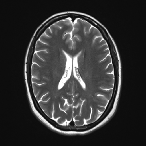 File:Cavernoma with bleed - midbrain (Radiopaedia 54546-60773 Axial T2 24).png