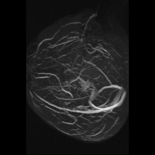 Cavernoma with developmental venous anomaly (Radiopaedia 22470-22507 MRV 14).jpg