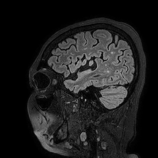 File:Cavernous hemangioma of the cerebellar falx (Radiopaedia 73025-83724 Sagittal FLAIR 40).jpg