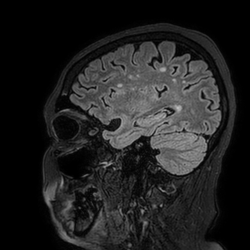 Cavernous hemangioma of the cerebellar falx (Radiopaedia 73025-83724 Sagittal FLAIR 53).jpg