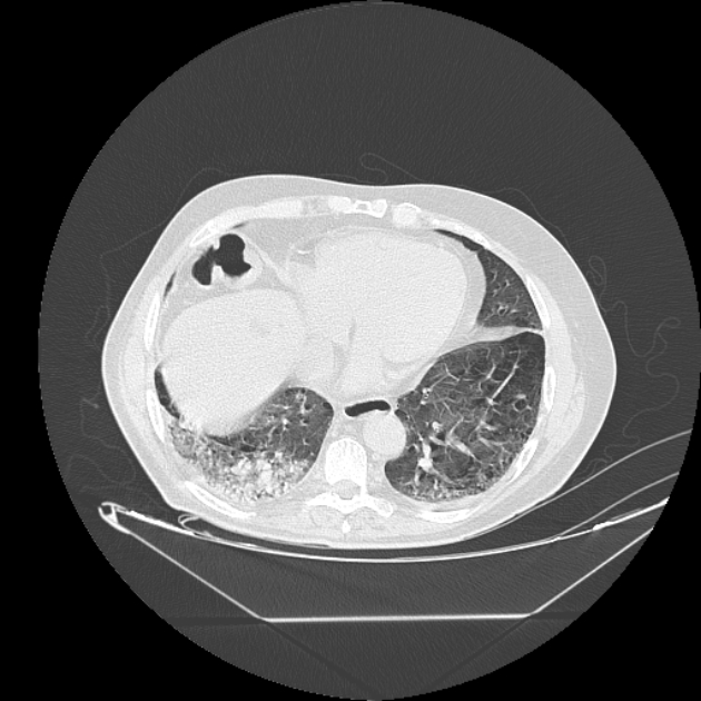 Cavitating bronchogenic carcinoma (Radiopaedia 44489-48162 Axial lung window 61).jpg