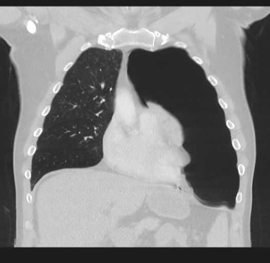 Cavitating pneumonia complicated by pneumothorax (Radiopaedia 48149-52994 Coronal lung window 20).png