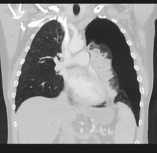File:Cavitating pneumonia complicated by pneumothorax (Radiopaedia 48149-52994 Coronal lung window 28).png