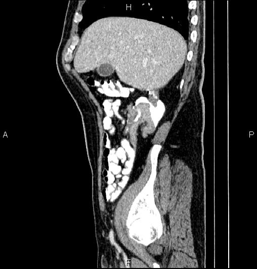 Cecal adenocarcinoma (Radiopaedia 85324-100916 E 19).jpg