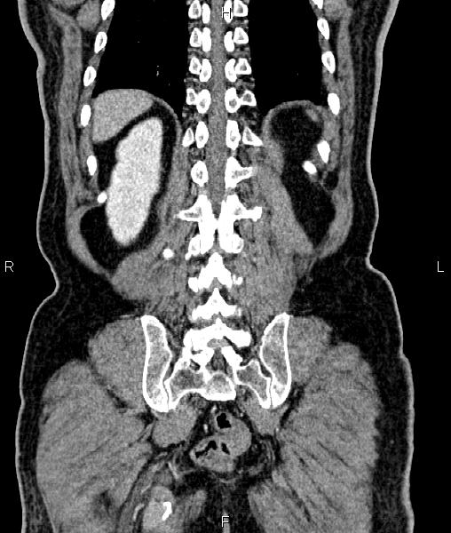 Cecal cancer with appendiceal mucocele (Radiopaedia 91080-108651 D 61).jpg