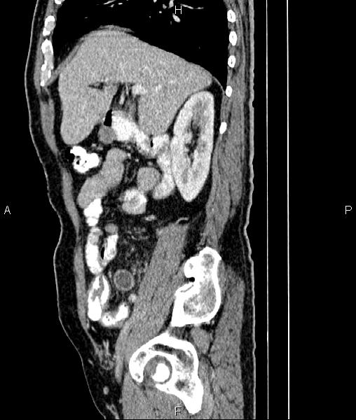 File:Cecal cancer with appendiceal mucocele (Radiopaedia 91080-108651 E 31).jpg