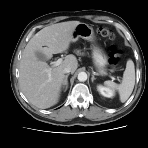 Cecal mass causing appendicitis (Radiopaedia 59207-66531 A 23).jpg