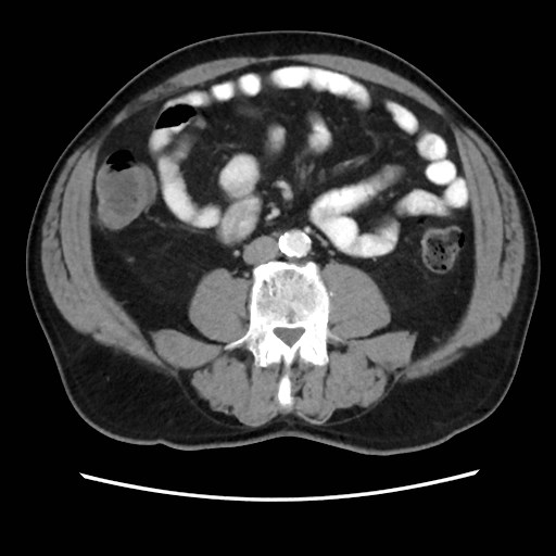 Cecal mass causing appendicitis (Radiopaedia 59207-66531 A 49).jpg