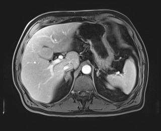 Cecal mass causing appendicitis (Radiopaedia 59207-66532 T1 C+ PV phase 39).jpg