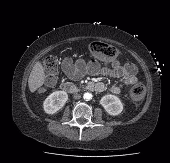 Celiac artery severe stenosis and dissection (Radiopaedia 44128-47842 B 45).jpg