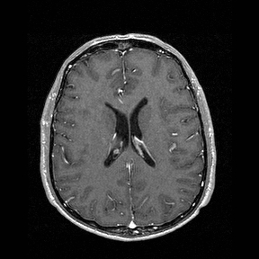 Central-variant posterior reversible encephalopathy syndrome (PRES) (Radiopaedia 43880-47358 Axial T1 C+ 101).jpg